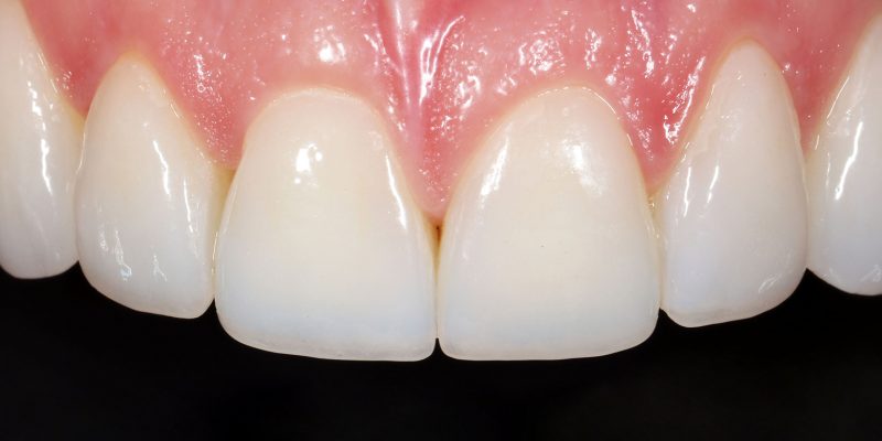 zahnmedizin-premium-veneers-praxis-dr-wytek-und-partner-darken