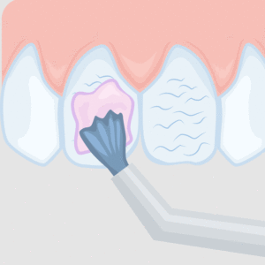 Veneers - Befestigung