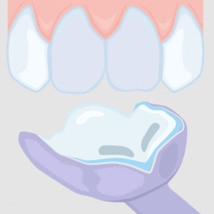 Veneers - Abdruck und Herstellung