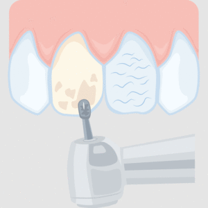 Veneers - Vorbereitung der Zaehne