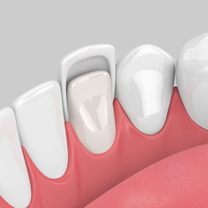 Veneers_Einsatz_Schema
