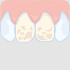 Veneers – Untersuchung und Vorbereitung